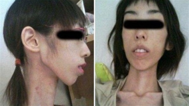 دختر ژاپنی بخاطر شکنجه های پدربزرگ و مادربزرگش, کاهش وزن عجیبی را تجربه کرده و حالا فقط ۱۷ کیلوگرم وزن دارد.