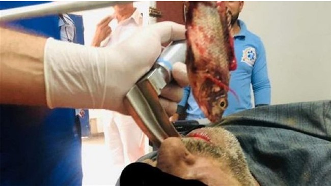 ماهی گیر مصری که یک ماهی زنده را قورت داده بود، توسط پزشکان نجات یافت.