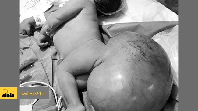 پزشکان بیمارستانی در امارات متحده عربی نوزادی را که به دلیل نوعی نارسایی نادرِ مادرزادی با توموری به وزن ۱.۵ کیلوگرم به دنیا آمده بود تحت عمل جراحی قرار دادند.