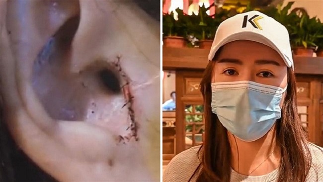 زن ۳۱ ساله ای که بینی خود را عمل زیبایی کرده بود پس از چند روز متوجه شد جراح بخشی از گوش او را در حین عمل بریده است.