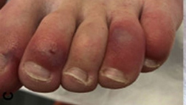 تحقیقات نشان می‌دهد برخی از بیماران کرونایی به عارضه‌ای موسوم به  انگشتان کرونا  دچار شده اند.