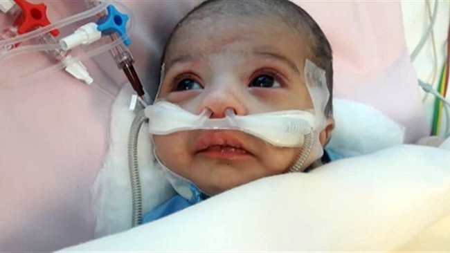 جراحی قلب باز نوزاد ۲۶ روزه با تشخیص کوارکتاسیون آئورت در بیمارستان رضوی مشهد با موفقیت انجام شد.