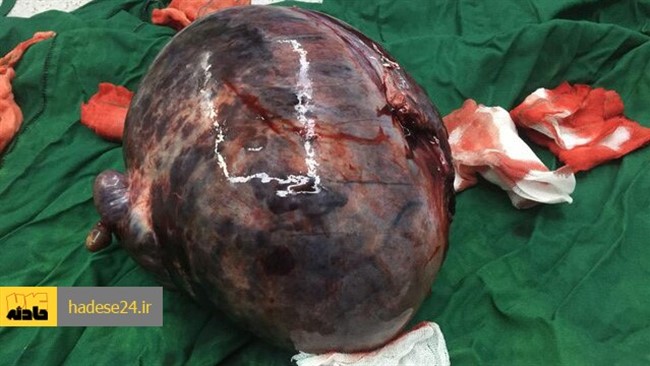 یک پزشک متخصص جراحی عمومی بیمارستان شهید بهشتی گفت: این بیمار هم استانی به علت سرطان پیشرفته کلیه چندین بار به استان های مجاور جهت درمان مراجعه نمود ولی به علت ریسک بالای جراحی و داشتن شرایط قلبی و ریوی نامناسب و کم خونی شدید و ریسک بالای مرگ و میر تحت عمل جراحی قرار نگرفته بود.