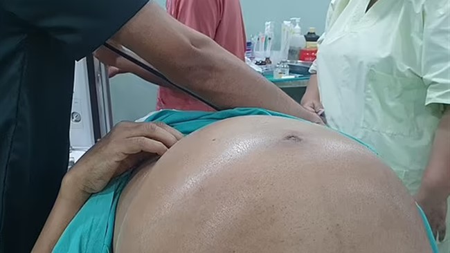 پزشکان هندی موفق به خروج توده ده کیلویی از شکم یک بیمارشدند.