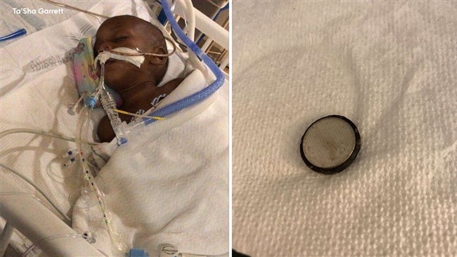 یک کودک دو ساله عربستانی یک باتری دکمه‌ ای را بلعید و به مدت هفت روز با وجود باتری در معده اش زنده ماند.