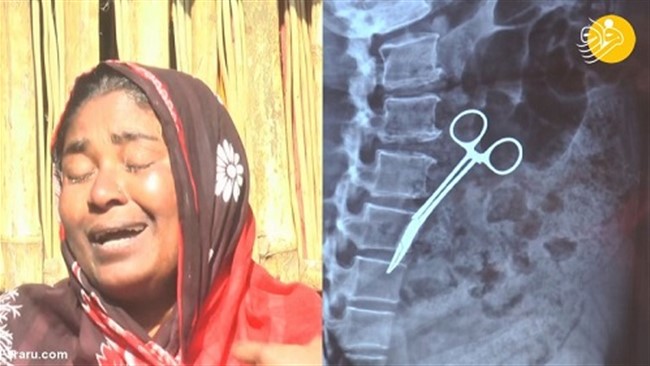 یک زن در بنگلادش که در سال ۲۰۰۲ عمل برداشتن کیسه صفرا را انجام داده بود، دائما از درد شکم رنج می‌برد تا اینکه پس از ۲۰ سال مشخص شد یک قیچی جراحی در شکمش جا مانده است.