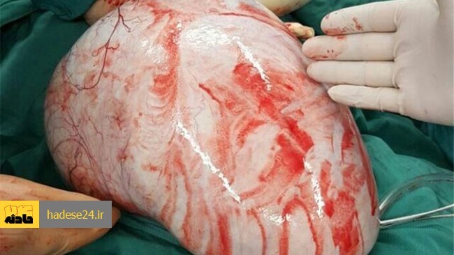 رئیس اتاق عمل بیمارستان امام رضا(ع) کبودراهنگ از جراحی موفقیت‌آمیز و خارج کردن یک توده رحمی ۲۵۰۰ گرمی از شکم یک زن جوان در این شهرستان خبر داد.