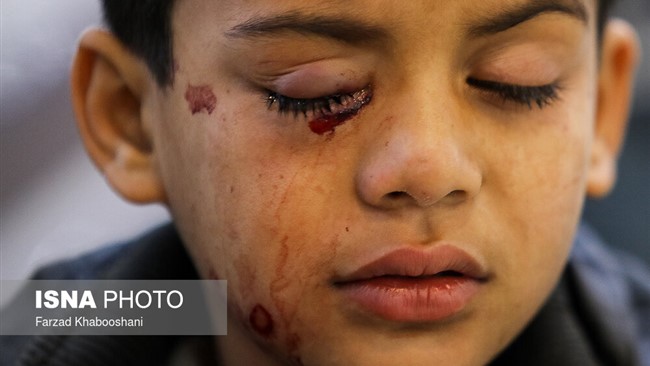 اولین حادثه چهارشنبه سوری امسال یزد با آسیب به چشم پسربچه ۱۲ ساله در این شهر رقم خورد.