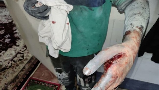 فرمانده انتظامی شهرستان کمیجان از انفجار نارنجک چهارشنبه سوری در دست نوجوان ۱۳ ساله و قطع سه انگشت دست او خبر داد.