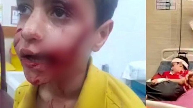 کودک ۱۱ ساله مسجدسلیمانی که بر اثر حمله سگ‌های ولگرد به شدت مجروح شده بود، پس از چند روز بستری در بیمارستان جان باخت.
